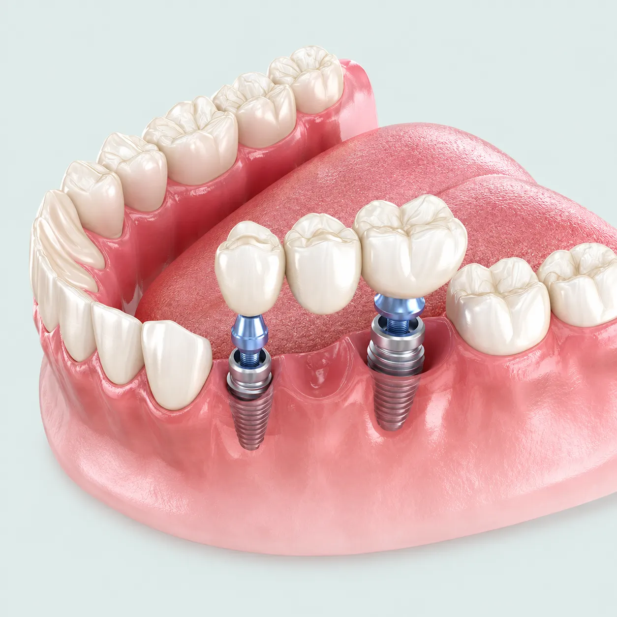 Bridge sur implants : deux implants dentaires portent un bridge de trois dents, la dent du milieu ne reposant sur aucun implant